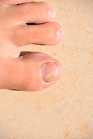How Fast Does Kerasal Make Nail Fall Off: Rapid Results Unveiled