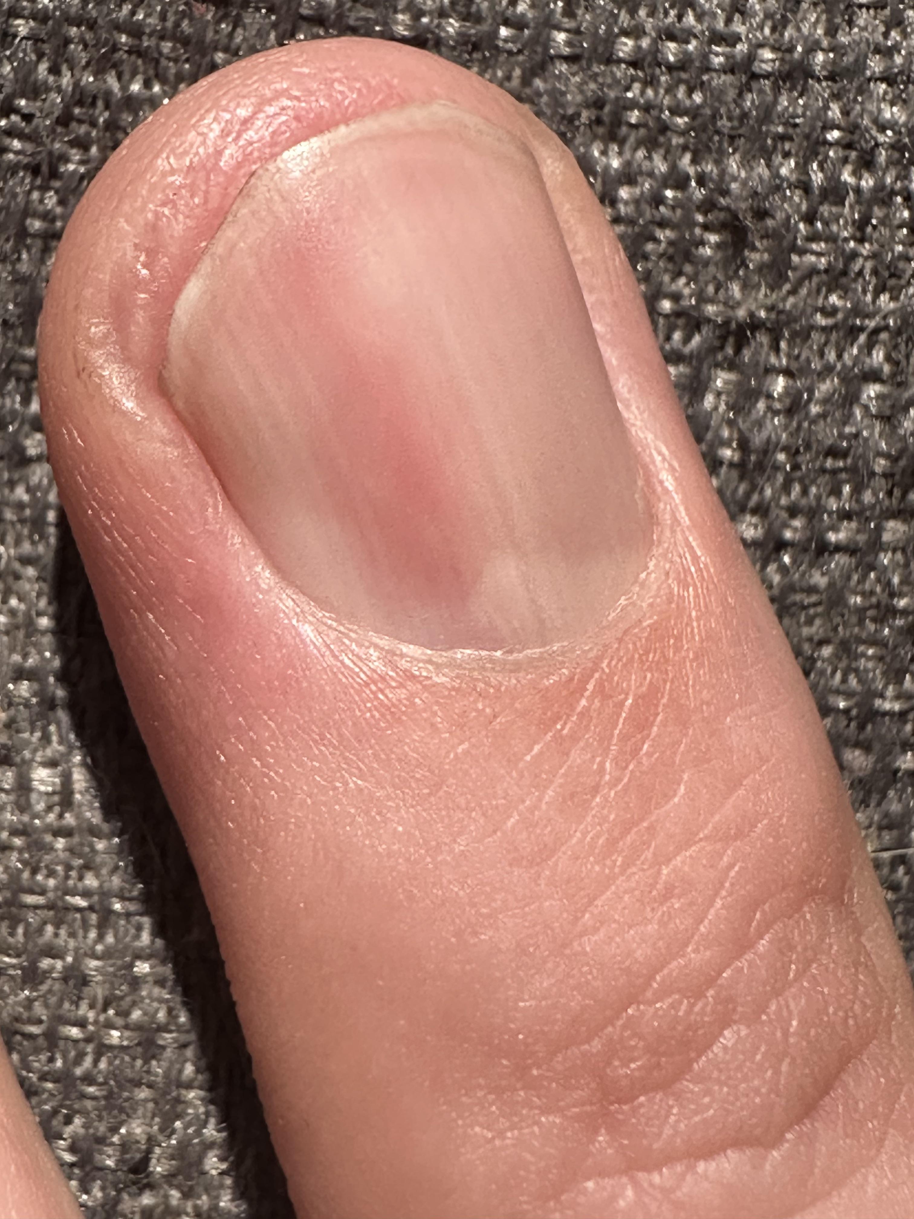 Throbbing Pain Under Fingernail No Injury: Quick Relief Tips