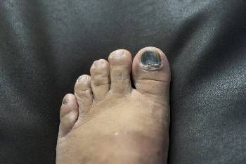 How Fast Does Kerasal Make Nail Fall Off: Rapid Results Unveiled
